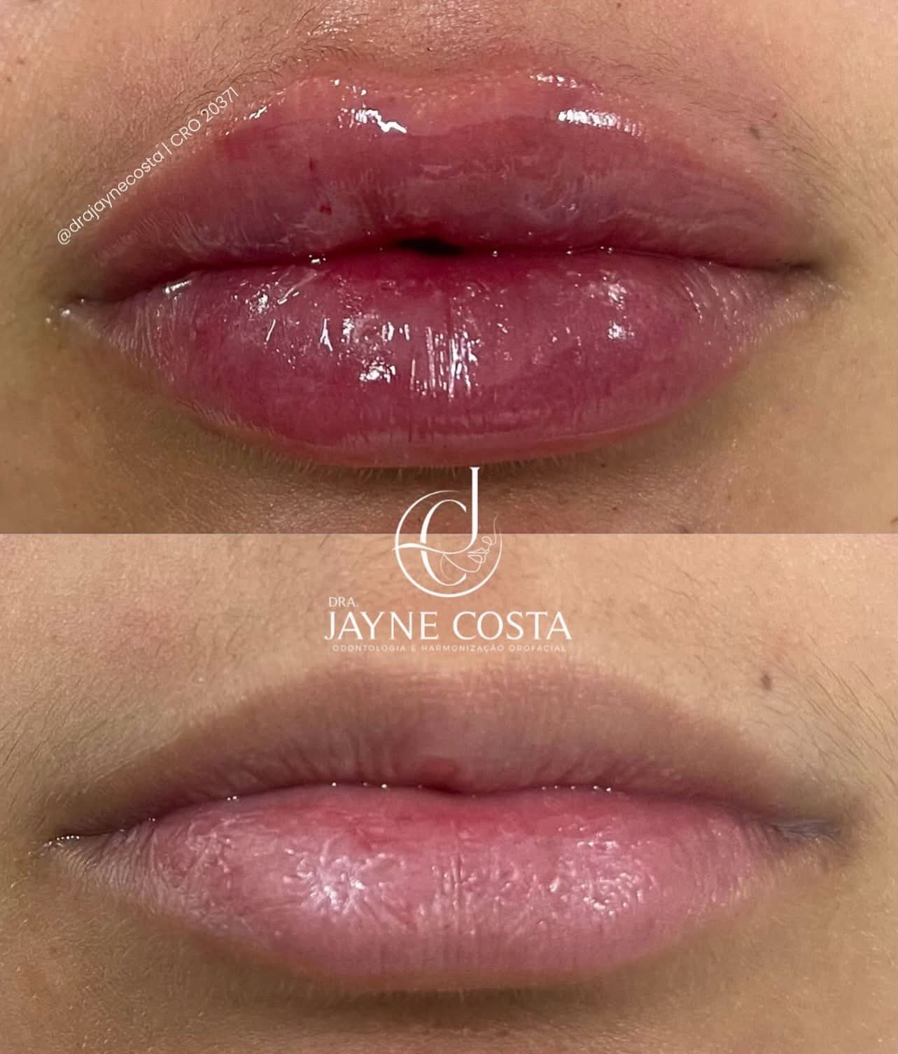 Antes do preenchimento labial